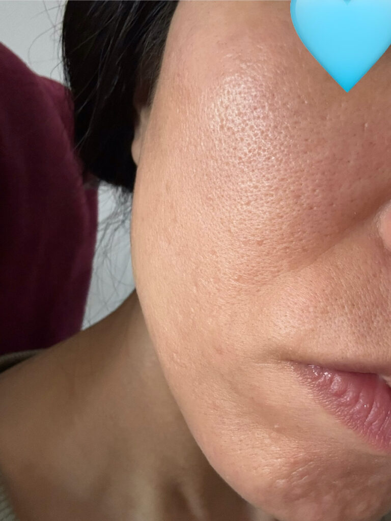 ポテンツァから3日後の経過